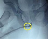 Инновационные методы в лечении стриктуры уретры