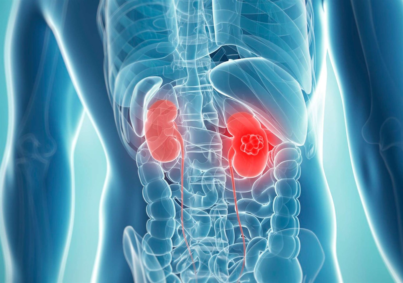Опухоль (рак) почки: симптомы, стадии и лечение