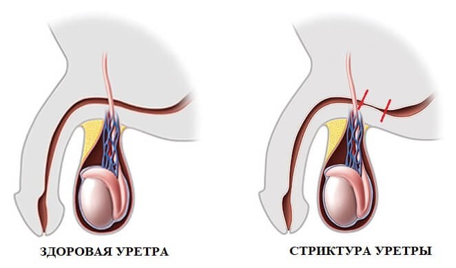 Стриктурная болезнь уретры: симптомы и лечение