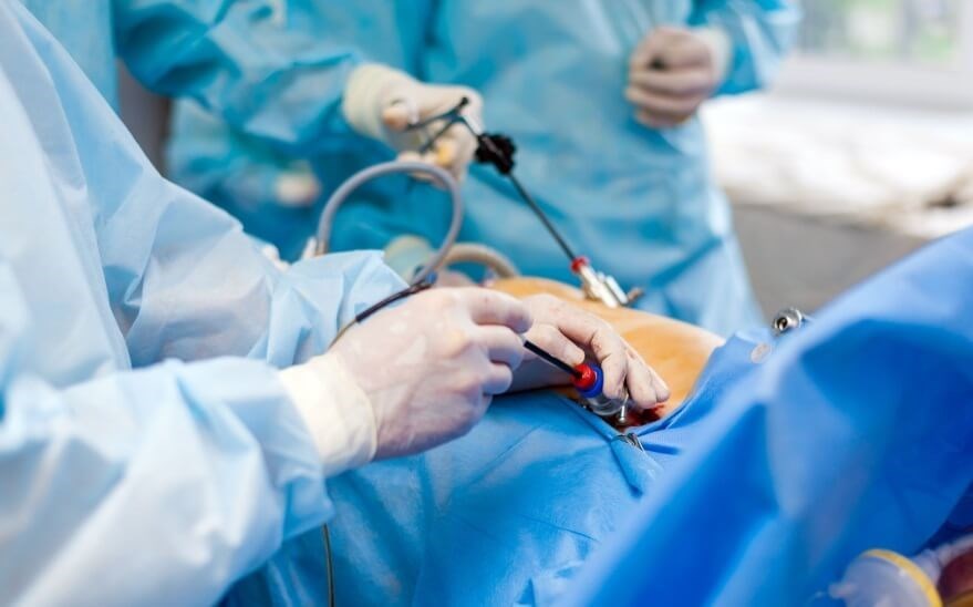 Лапароскопическая радикальная цистэктомия