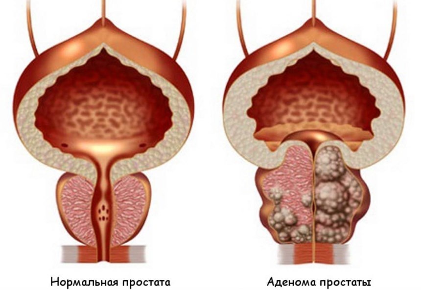 Аденома простаты: симптомы, диагностика и лечение у мужчин