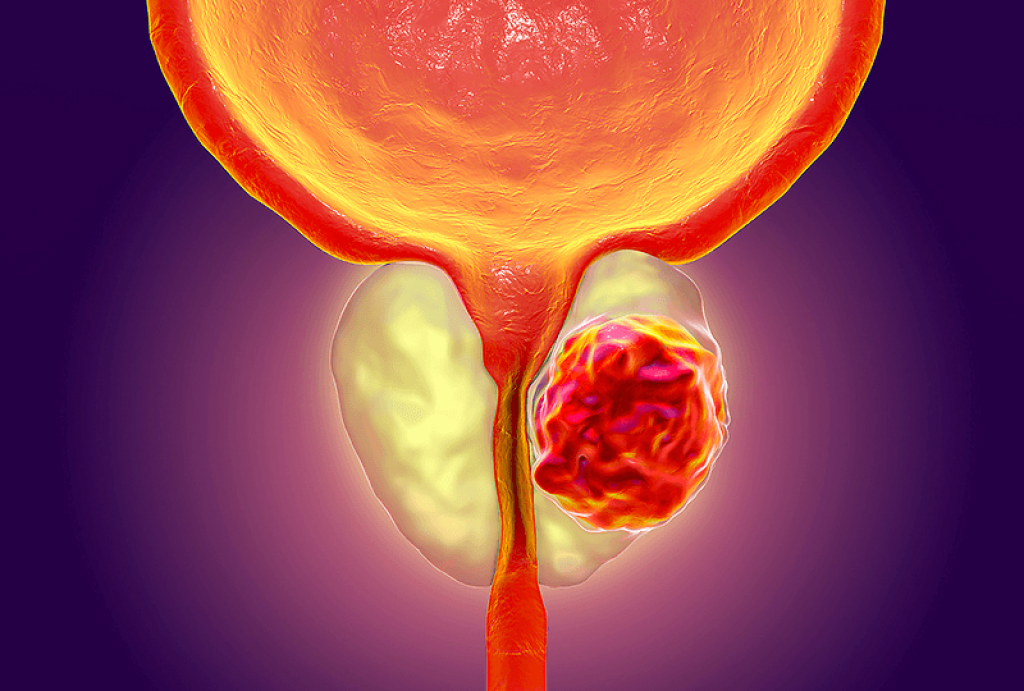 Эффективное лечение (удаление) аденомы простаты у мужчин