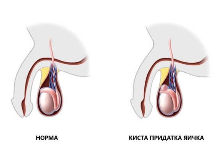 Киста придатка яичка: диагностика и лечение