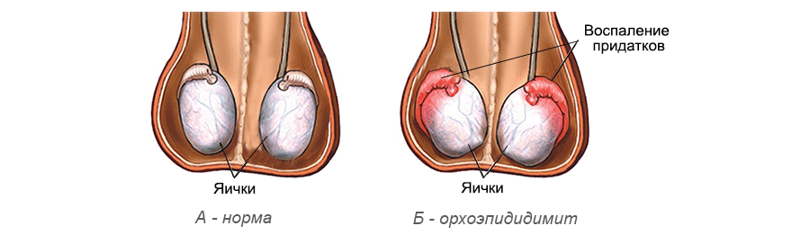 Орхоэпидидимит у мужчин: симптомы и лечение
