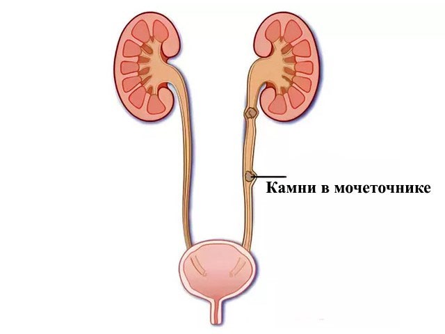 Уретеролитиаз (камень мочеточника): симптомы и причины