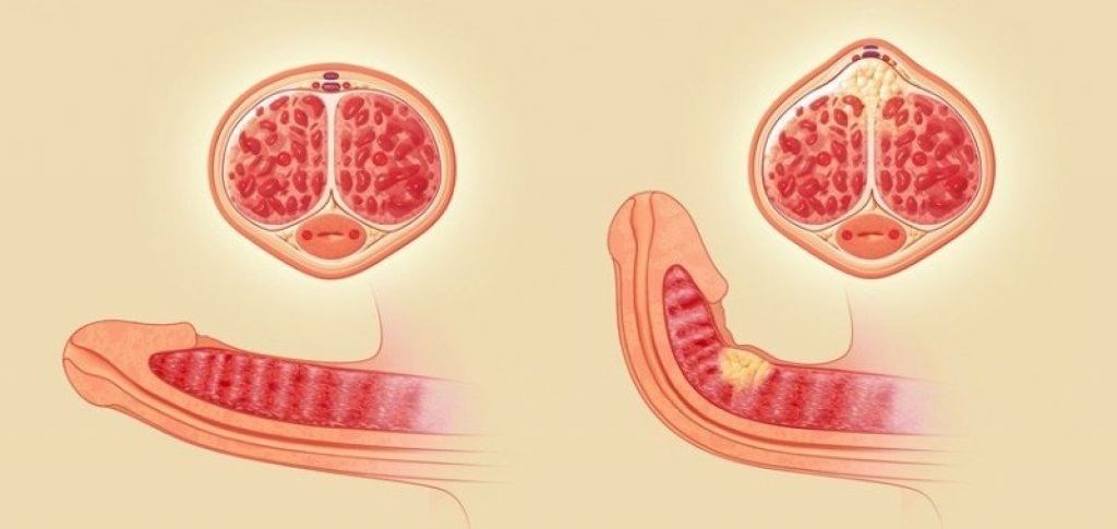 Болезнь Пейрони (искривление полового члена)