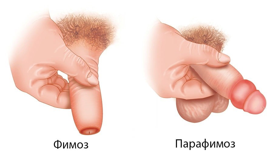 Фимоз и парафимоз у взрослых и детей
