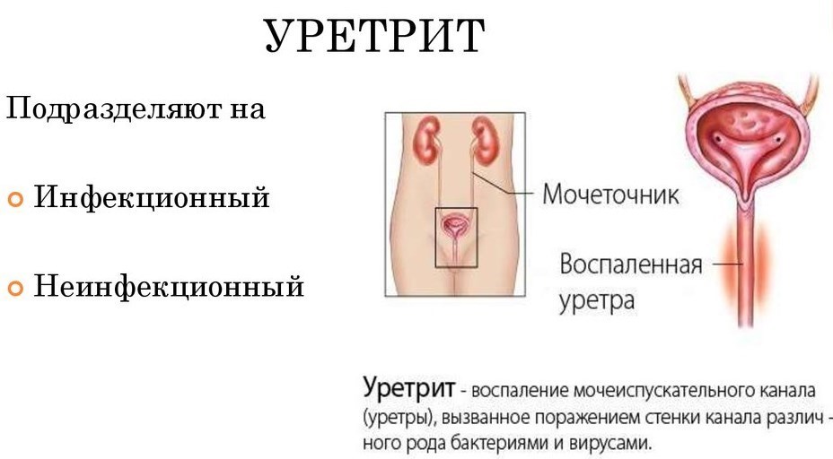 Уретрит: симптомы, причины и лечение