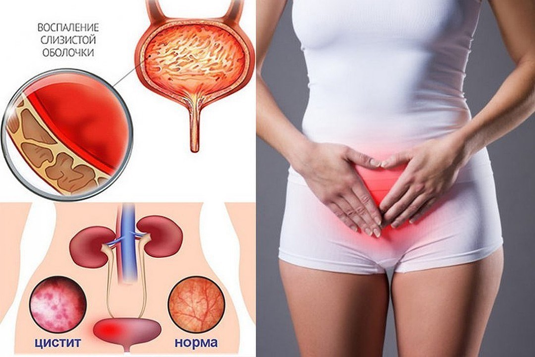 Посткоитальный цистит