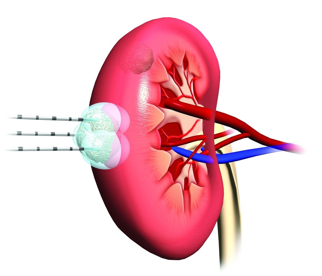 Гигантская ангиомиолипома (доброкачественная опухоль почки больших размеров)