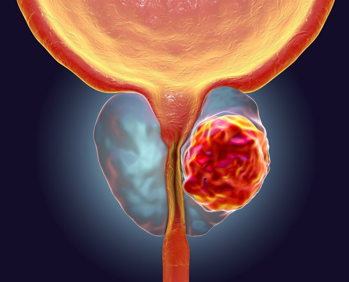 Местно-распространенный рак предстательной железы, синхронный рак почек